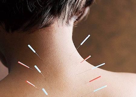 طب سوزنی برای درمان رگ به رگ شدن گردن