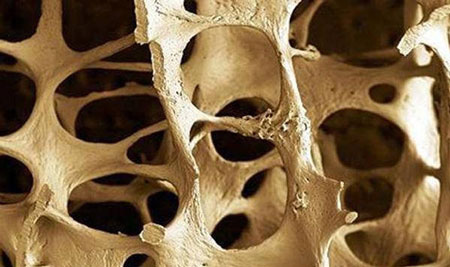 روش‌های تشخیص پوکی استخوان