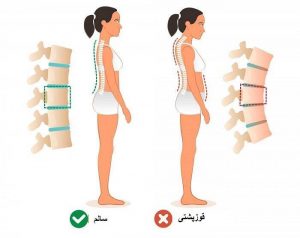 قوزپشتی (کیفوز) چگونه درمان میشود؟