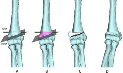 عمل جراحی استئوتومی چگونه باعث بهبود مشکل پای پرانتزی می‌شود؟