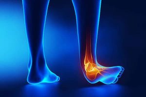 چگونه پیچ خوردگی و رگ به رگ شدن مچ پا را بدون جراحی درمان کنیم؟